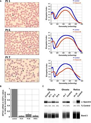 The Spectrum of SPTA1-Associated Hereditary Spherocytosis